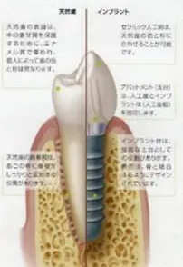 インプラント
