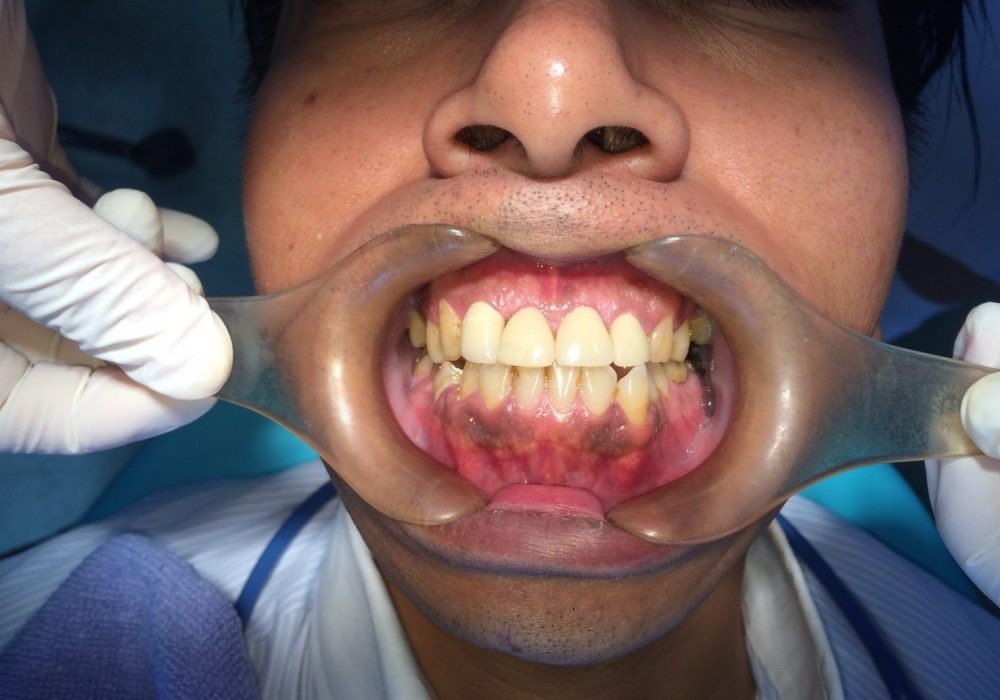 患者様の口腔内の状態や希望を丁寧に確認し、無理のない治療方法を提案しています。