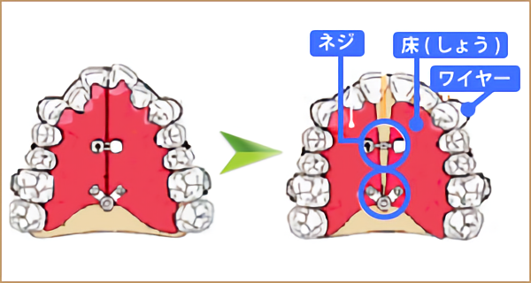 お子様の成長過程に合わせた小児矯正が行われています