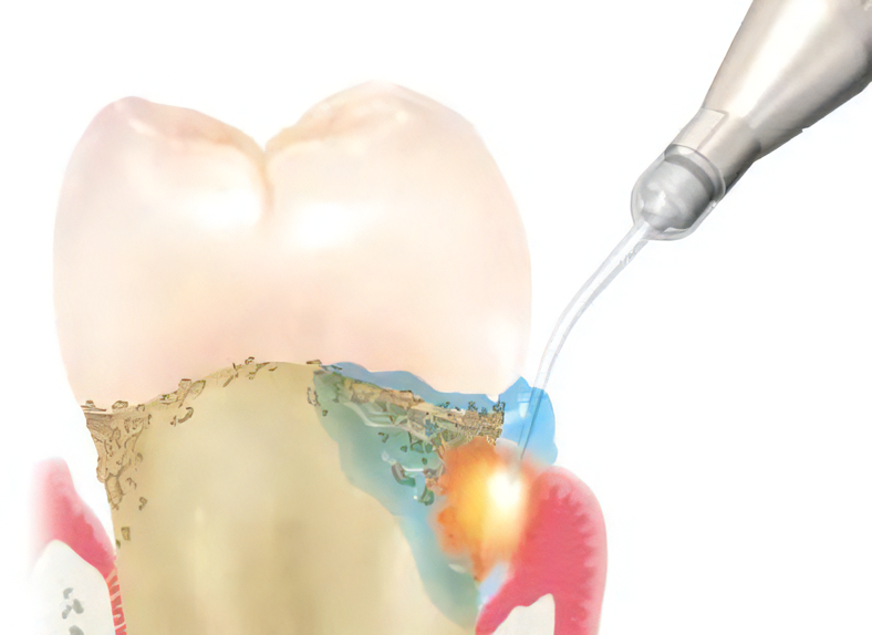 PDT(ペリオウェイブシステム)治療法を用いた歯周病治療