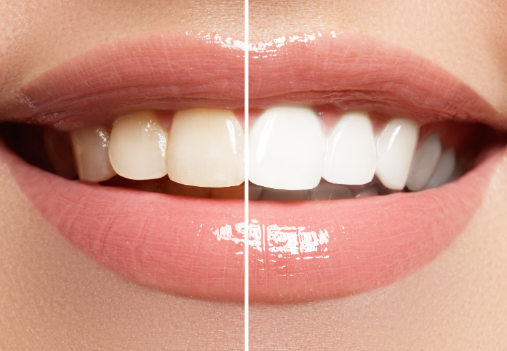 歯を白くして笑顔に自信をつけましょう