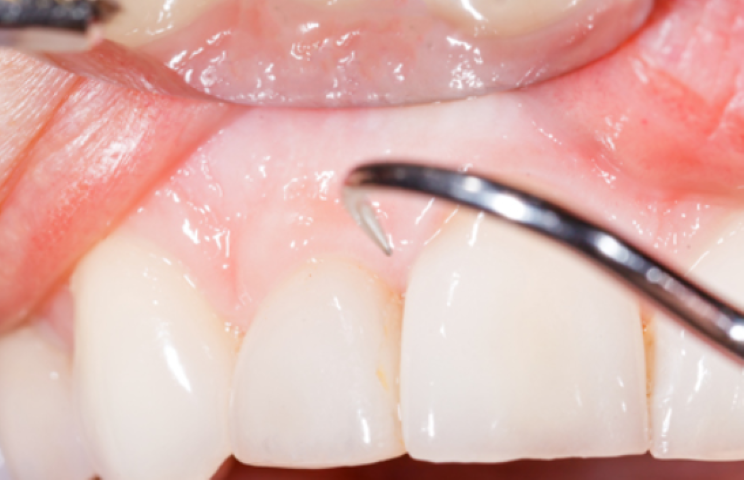 沈黙の病「歯周病」と向き合う