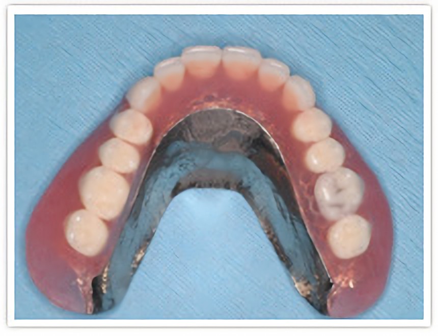 磁性アタッチメント、金属床義歯の症例