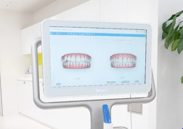 前歯だけの矯正におすすめです