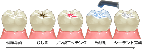 シーラントの流れ