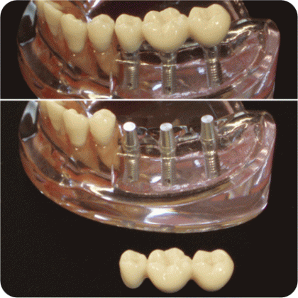 これまでに30年間で1,200本以上のインプラント埋入実績があります