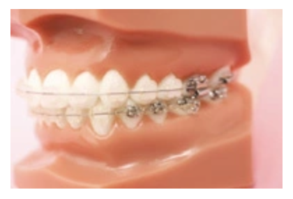 患者様のご希望に沿った矯正装置をご選択いただけます
