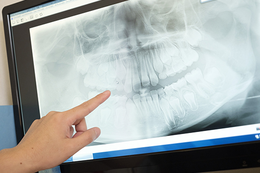 なるべく削らない治療を行います