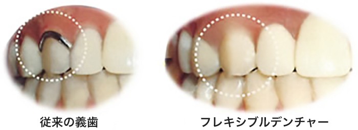 金属がなく目立ちにくいのが特徴です