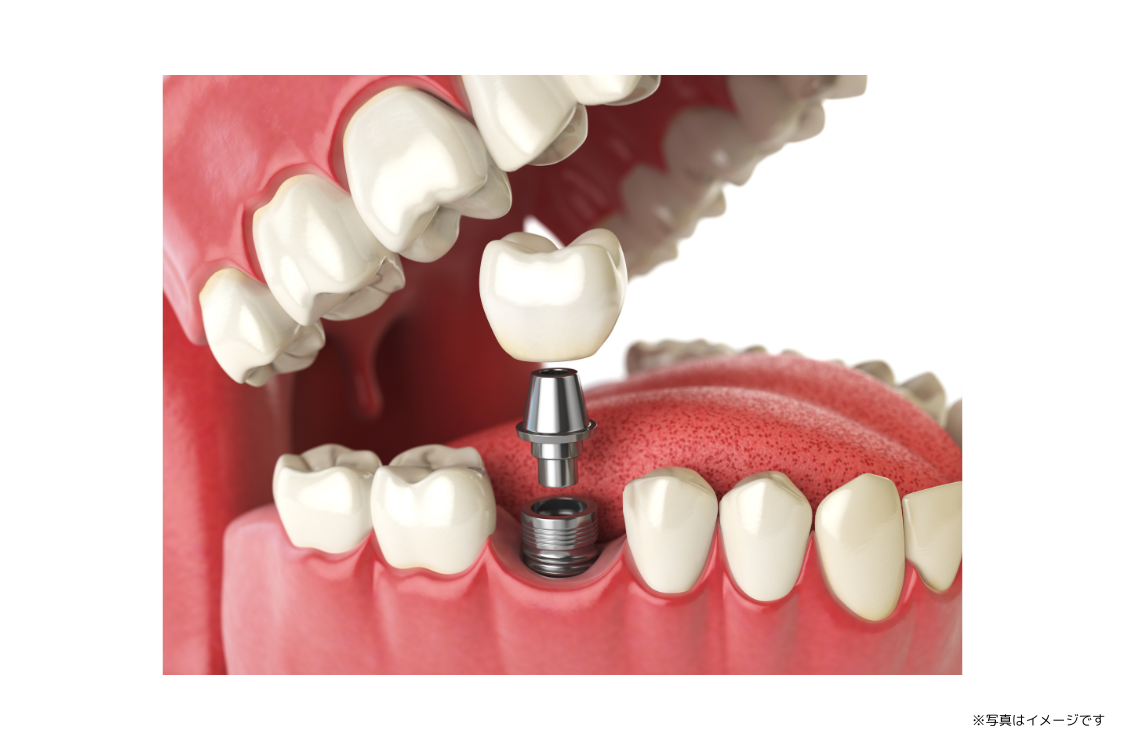 治療後のサポート体制も含め、長く快適に過ごせる口腔環境が提供されています