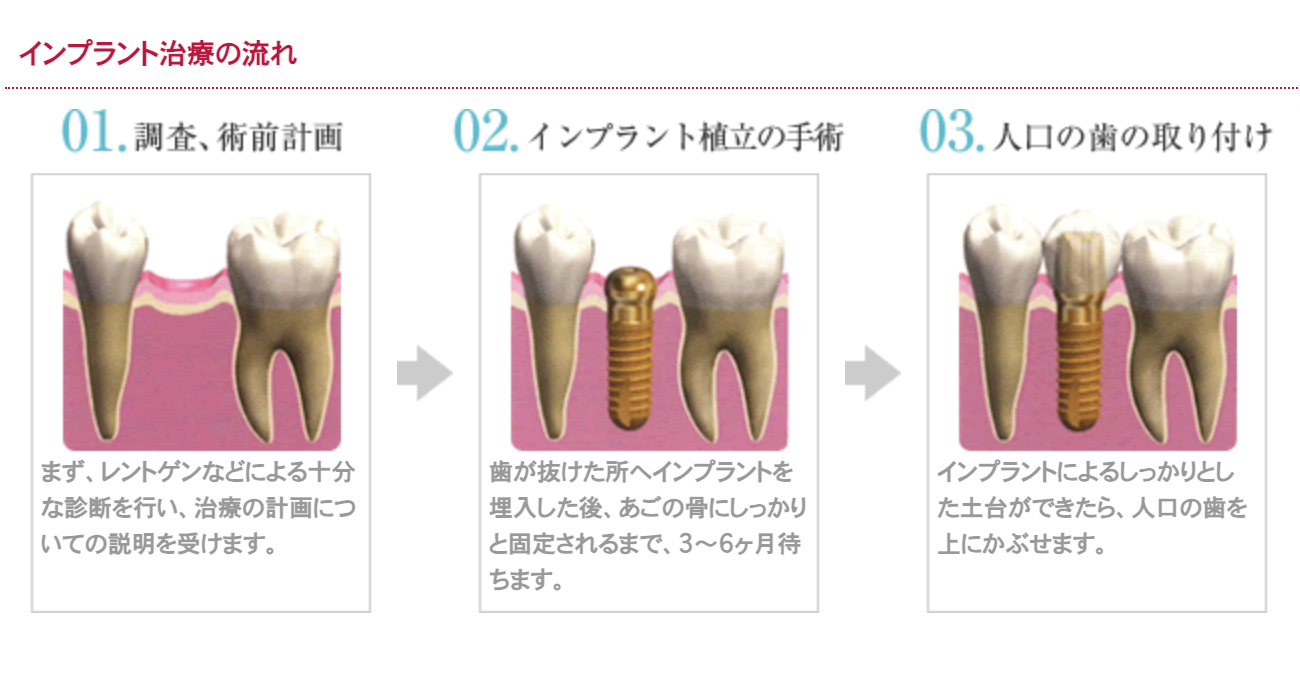 最適なインプラント治療を提案しています