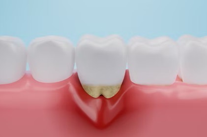 非プラーク性の特殊な歯周疾患にも対応しており、多角的な視点から原因を究明することが可能です