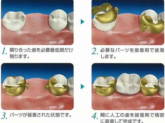 歯を失った際の画期的な補綴治療として「ヒューマンブリッジ」を提供しています