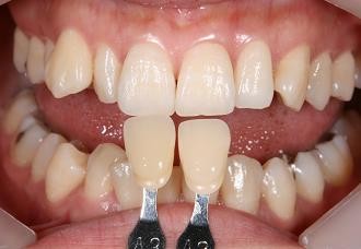 患者様のご希望の白さに近づけることができます