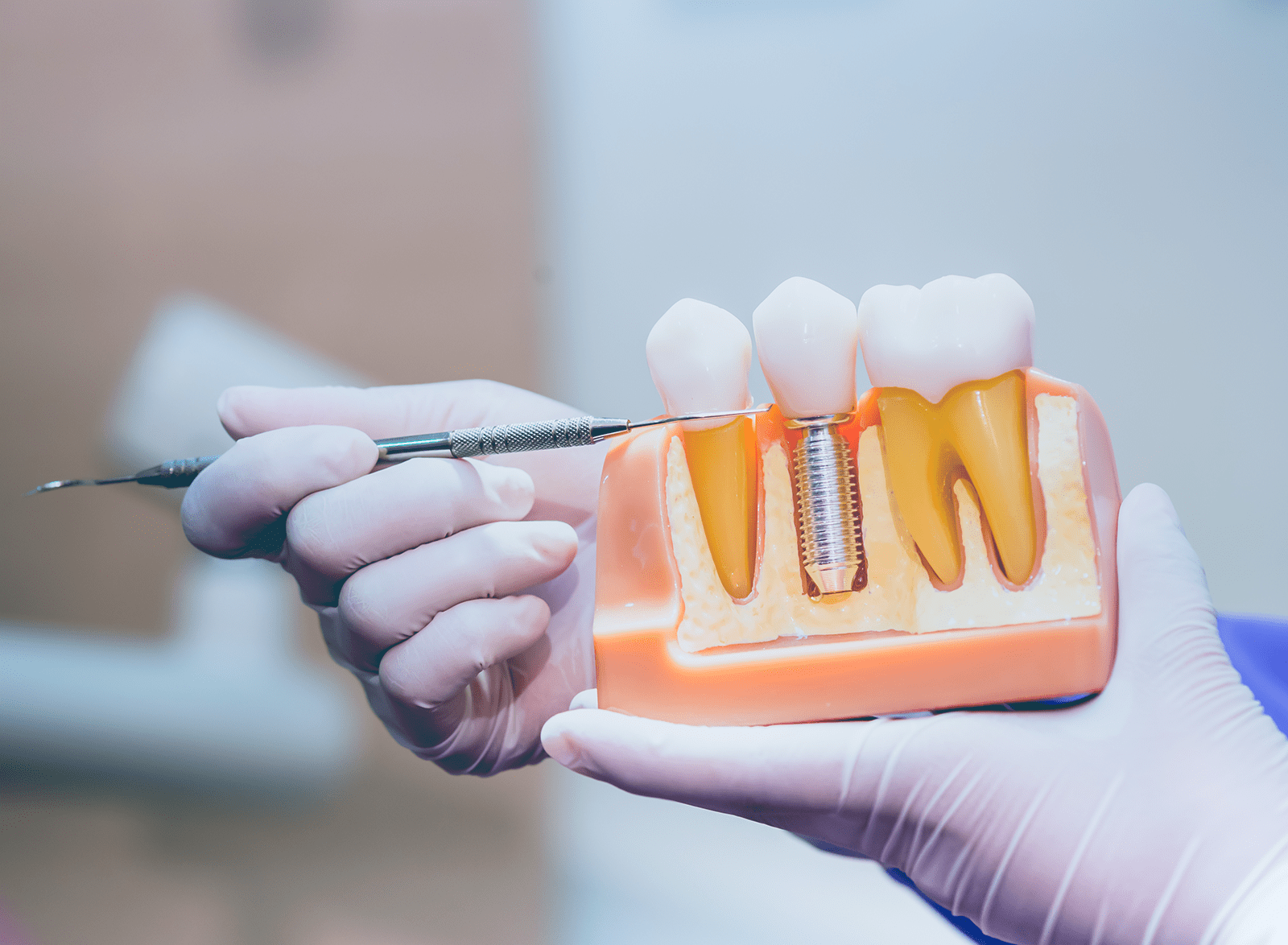 歯を失った際の治療法としてインプラントを提供しています