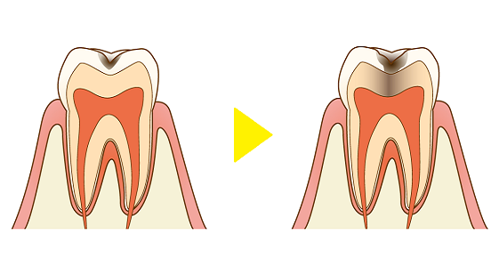 予防歯科と早期治療を組み合わせることで、治療の繰り返しを避け、患者様の歯の健康を守り続けることができます。