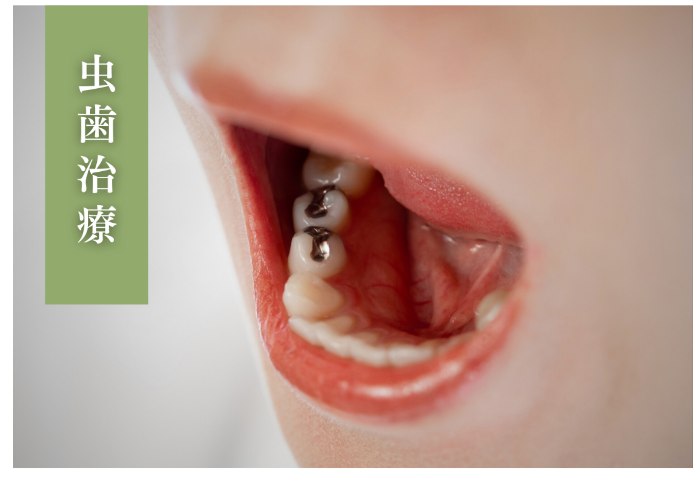 必要最低限の削合で歯を大切にしながら治療を行い、できるだけご自身の歯を長く保てるよう努めています