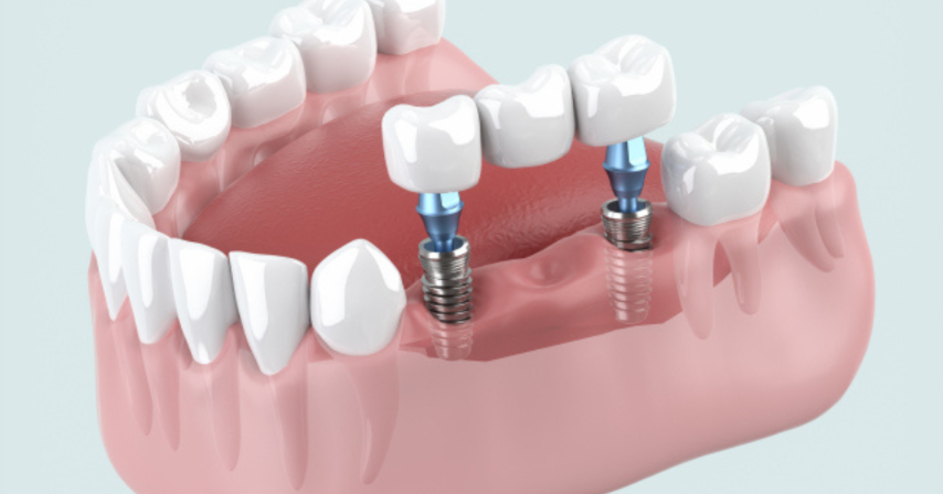 しっかり噛める喜びを
