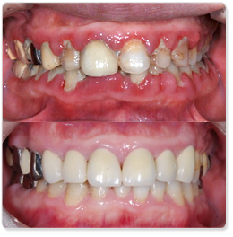 歯周病を正しく知って治療することが重要です。
