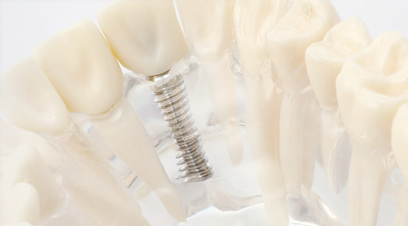 インプラント治療の一環として「オールオン4」にも対応しております