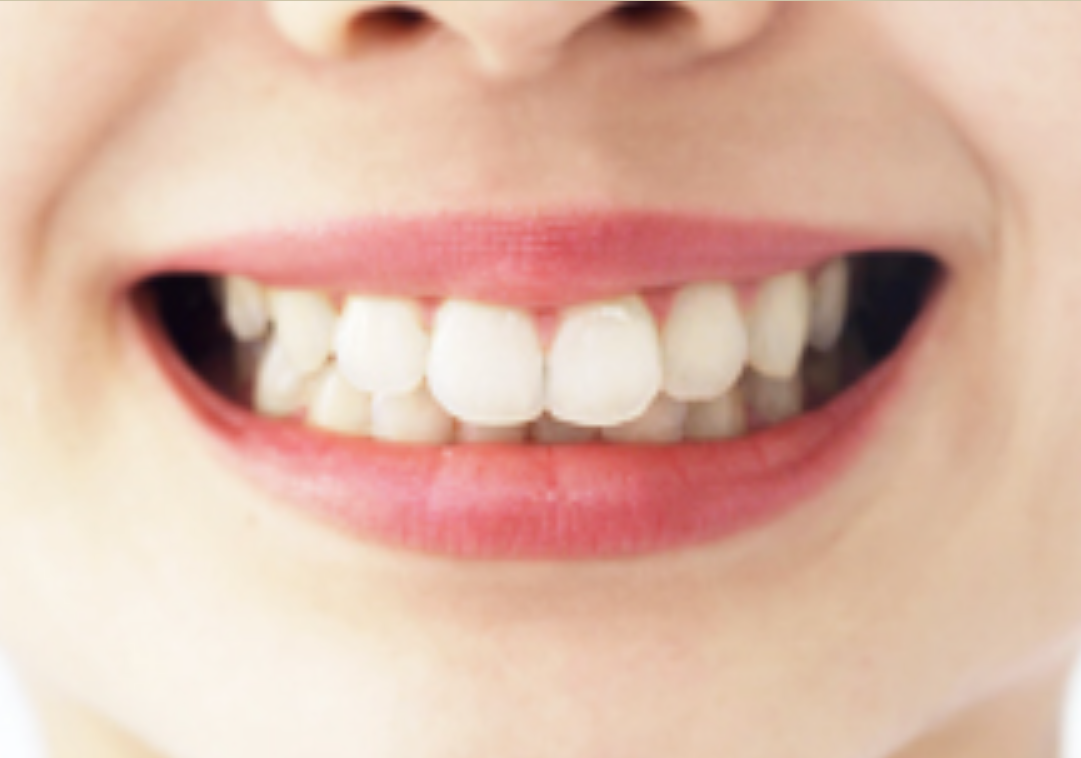 自然な歯に近い機能性と見た目を提供します。