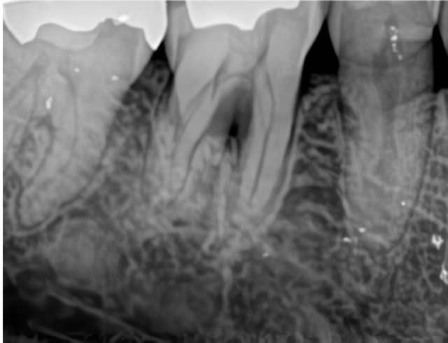 歯周病で失った骨を取り戻す歯周組織再生治療