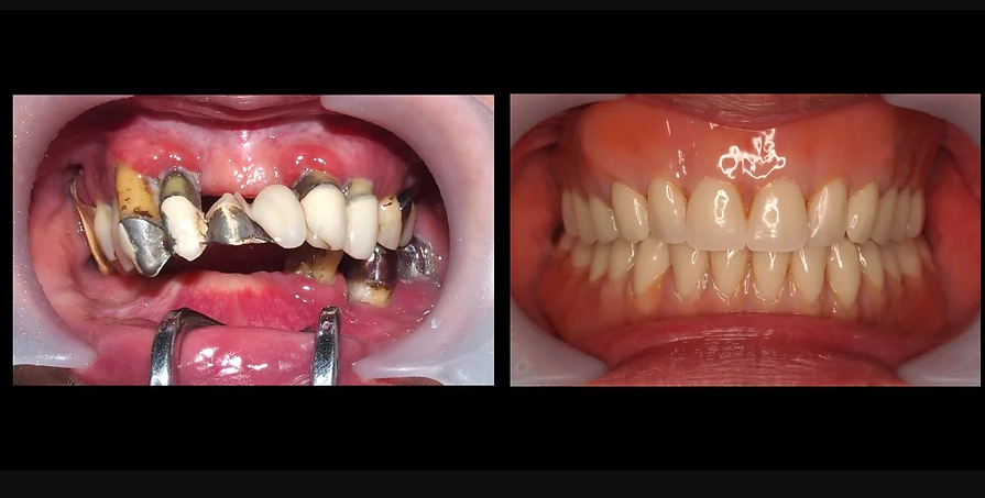 咬み合わせ治療