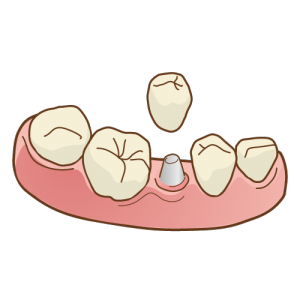 インプラントの絵