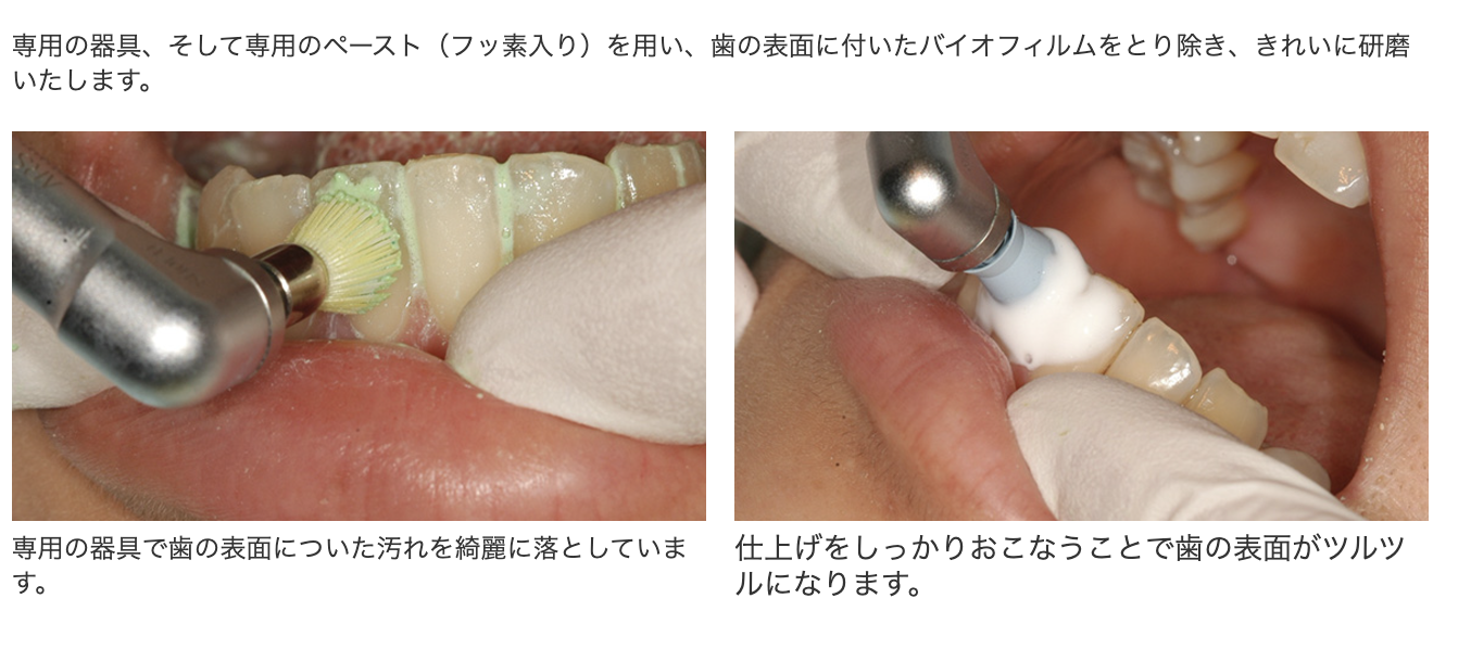 定期的なクリーニングを行うことで、長期的に健康で美しい歯を維持することができます