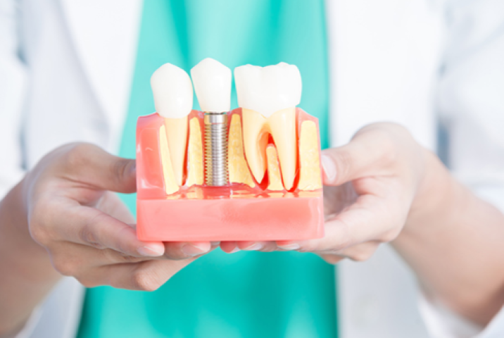 噛む力を取り戻すインプラント治療