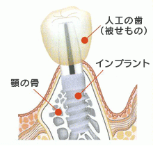 インプラントの仕組み