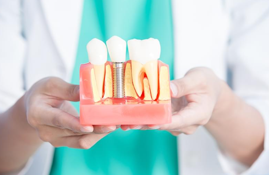 チタン製人工歯根と最適な施術で長期的な口腔機能を回復