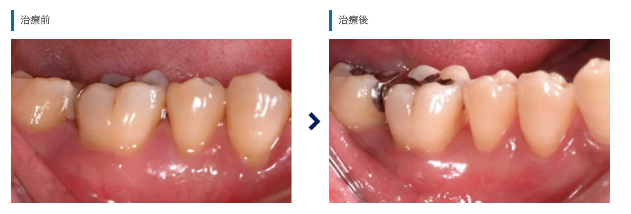 インプラント治療