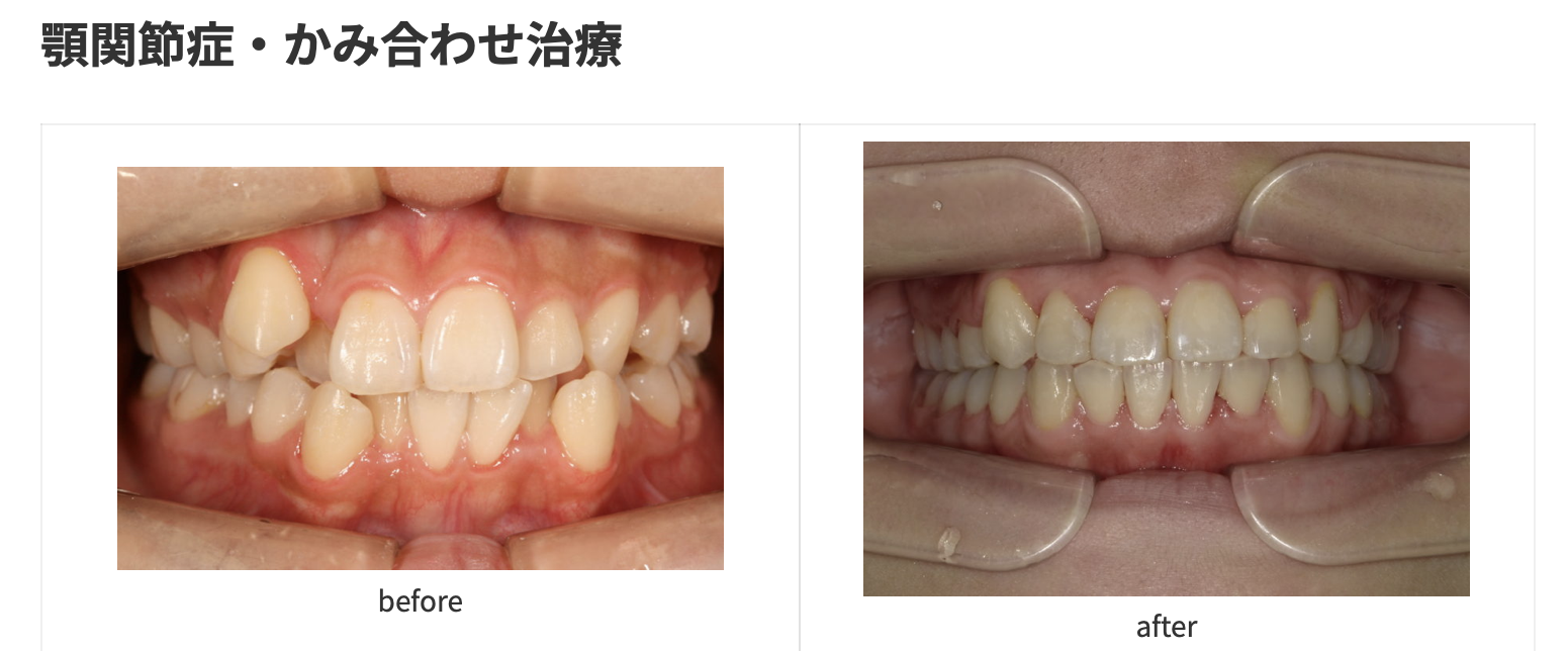 顎関節症・噛み合わせ治療