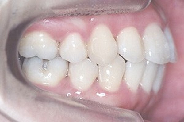 ある患者様の治療後の写真