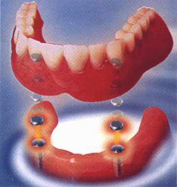 メリットの多いマグネットアタッチメント義歯を提案しています