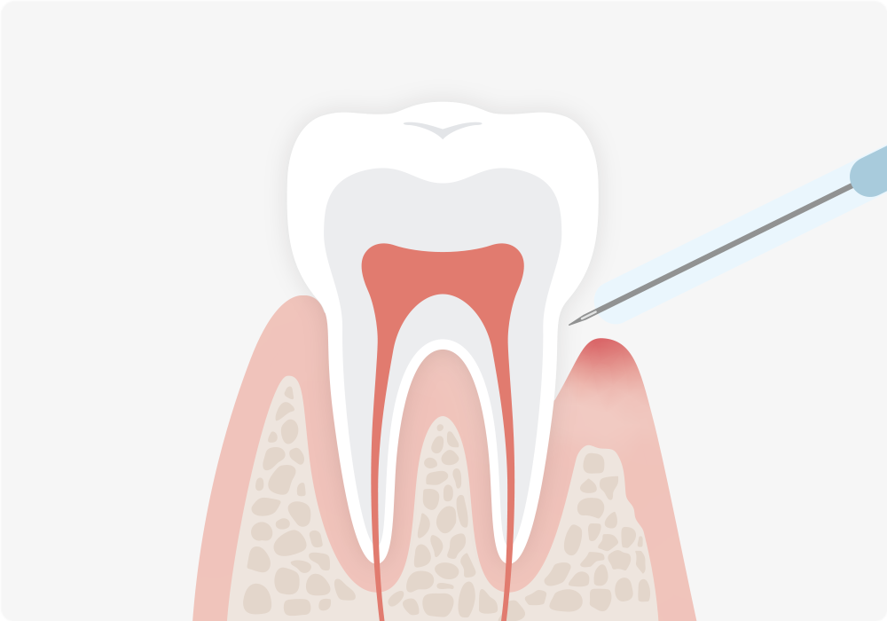 リグロスを用いて歯周組織の再生を促しています