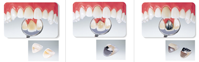 かぶせものの例