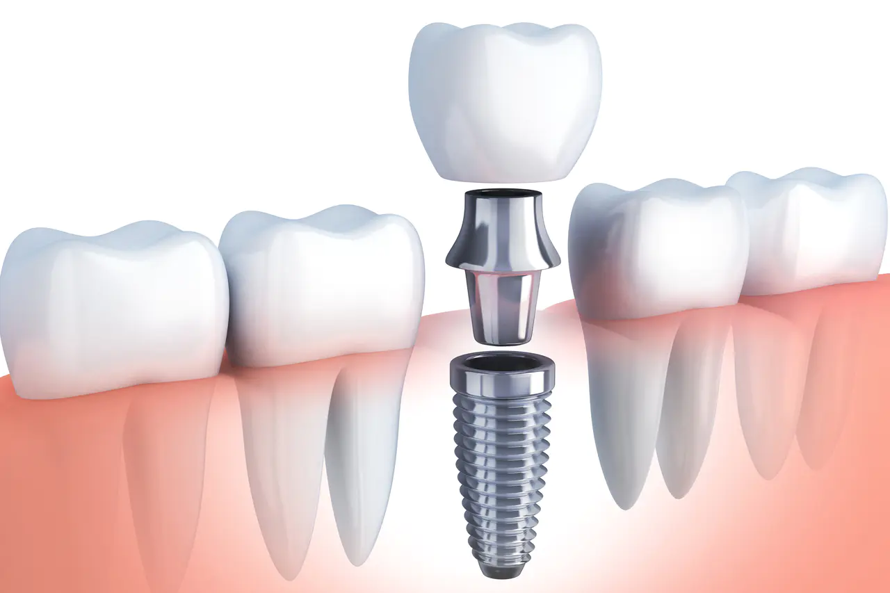 インプラントのイメージ図