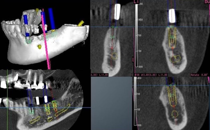 しっかり噛める快適な毎日を支えるインプラント治療