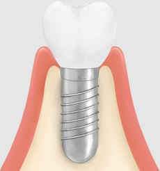 インプラント治療