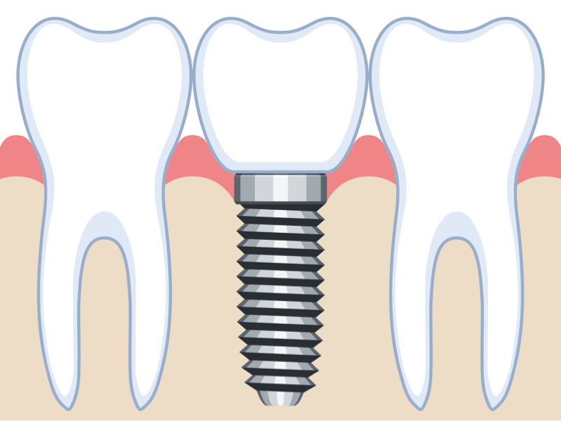インプラントのイメージ