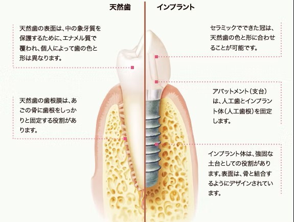 自分の歯のように自然に噛むことができます