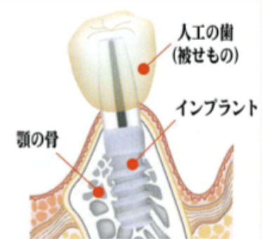 インプラント治療を通じて、健康で美しい笑顔を取り戻しましょう。