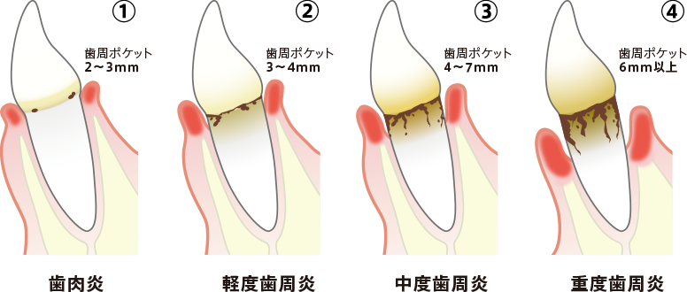 治療後は日々の歯磨きに加えて、定期的メンテナンスに通うことも重要です