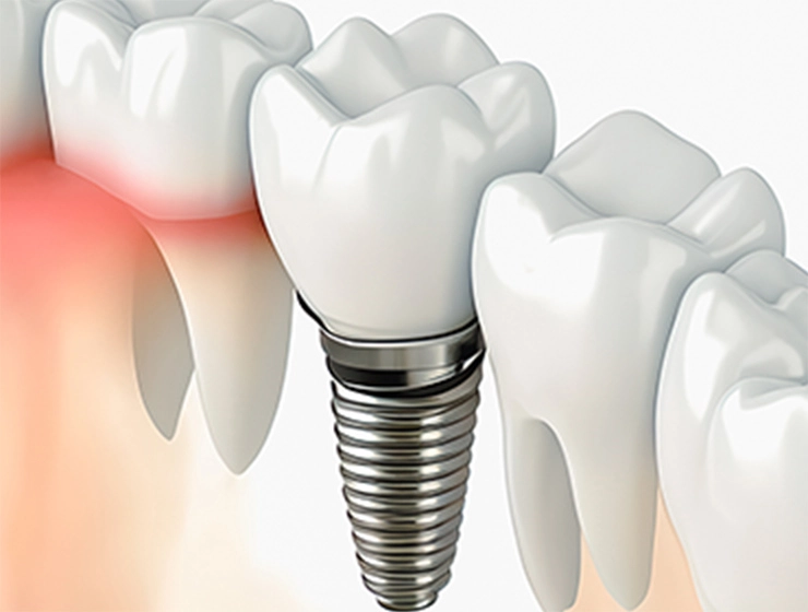 噛む力の回復まで見据えて治療計画を立てています