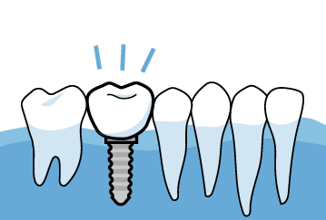 インプラントと骨を生着させやすくする「HAインプラント」を採用しています