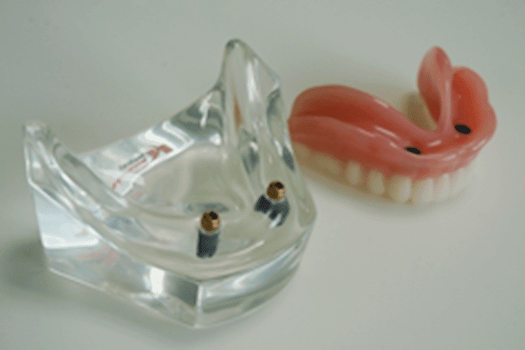 インプラントデンチャー