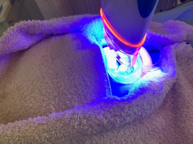 オフィスホワイトニングならば即効性を感じられます