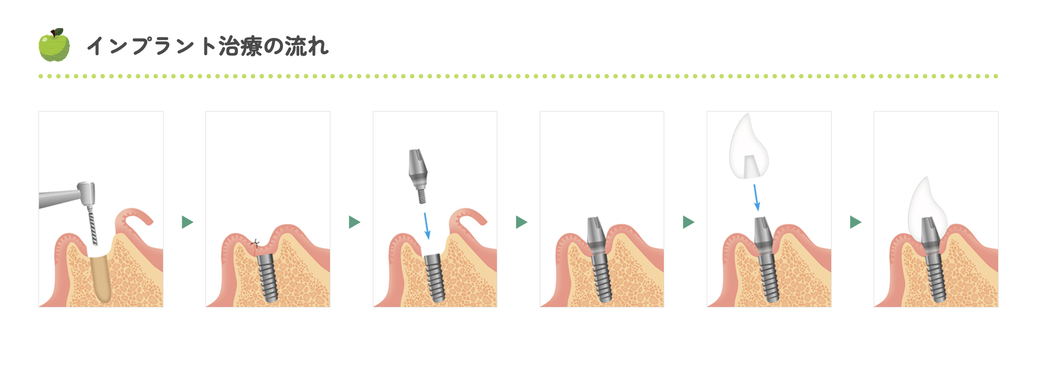 AQBインプラントを採用し、患者様一人ひとりの状態に合わせた治療を行っています